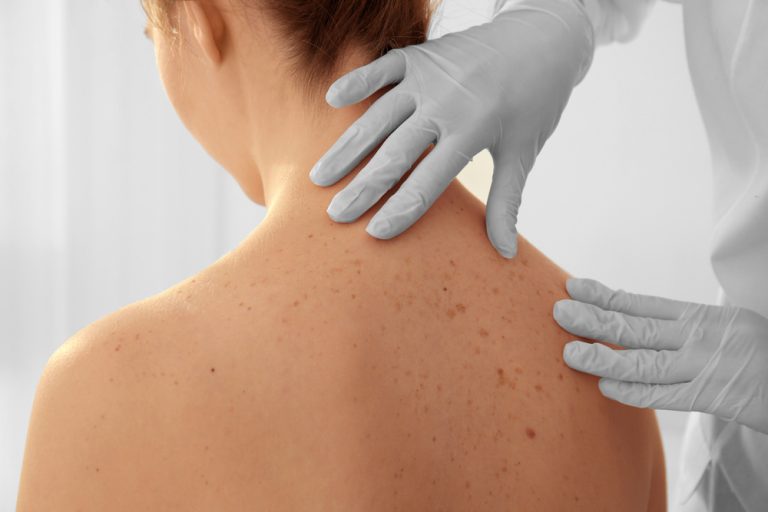 大皰性類天皰瘡（Bullous Pemphigoid） Recommended by Dr. Yeung Ho Hong 楊浩康